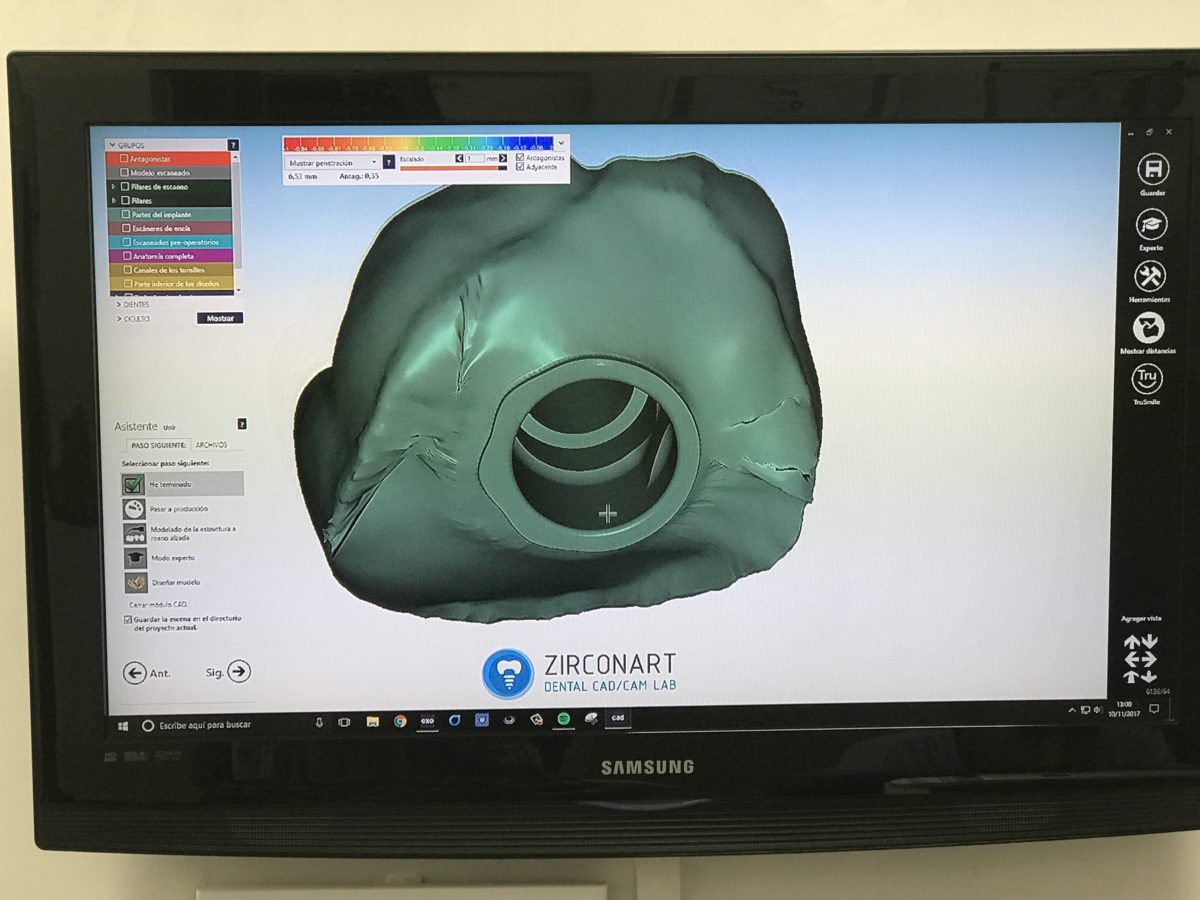 WORKSHOP: flujo de trabajo CAD-CAM, del escaneo intraoral al acabado ...